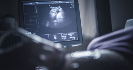 Representação médica de uma placenta humana com sinais de insuficiência.