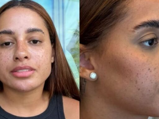 Influenciadora Lomma exibe resultado de harmonização facial