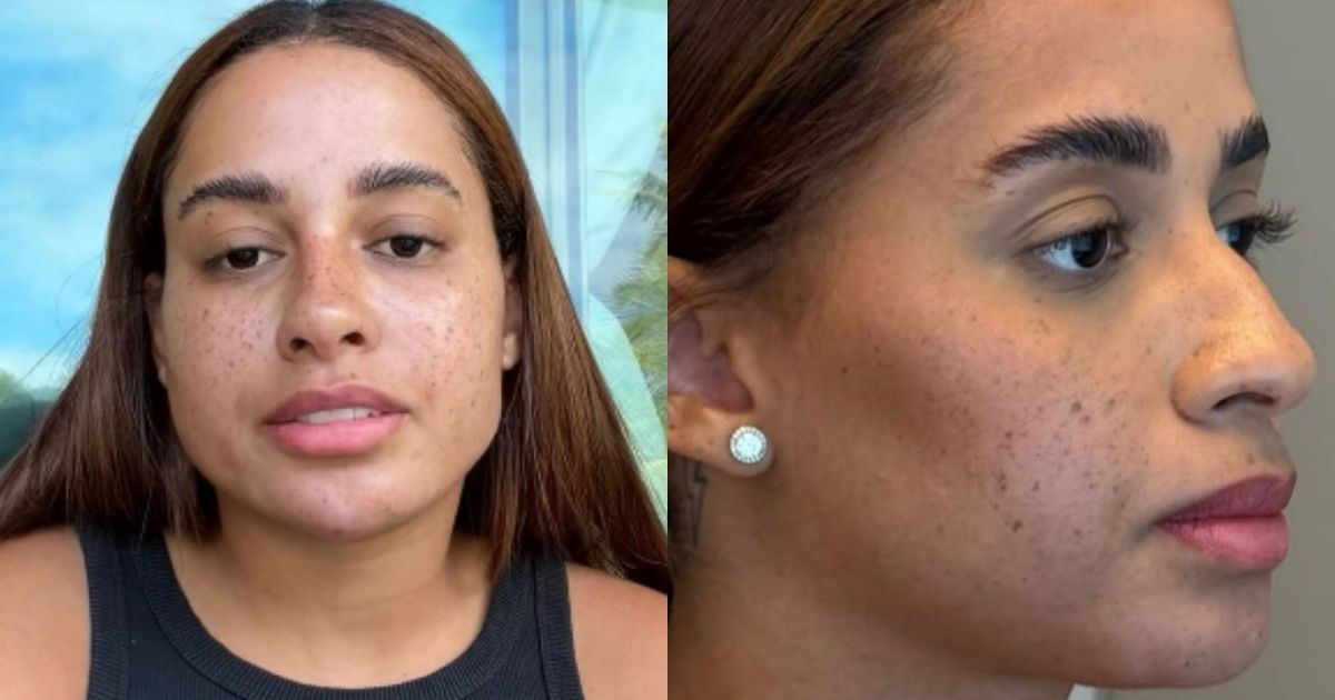 Influenciadora Lomma exibe resultado de harmonização facial